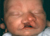 cleft palate babies and adults